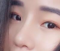 自體軟骨隆鼻手術(shù)果和恢復(fù)過(guò)程圖分享