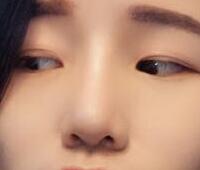 自體軟骨隆鼻手術(shù)果和恢復(fù)過(guò)程圖分享