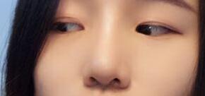 自體軟骨隆鼻手術(shù)果和恢復(fù)過(guò)程圖分享