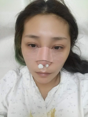 周長兵給我做的隆鼻整形恢復(fù)得好自然