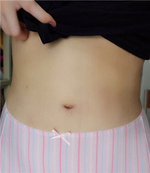 周長兵做的水動(dòng)力吸脂瘦腰腹 大肚腩沒有了