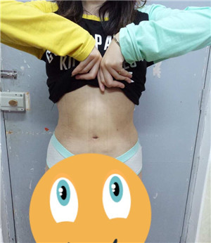 周長兵做的水動(dòng)力吸脂瘦腰腹 大肚腩沒有了