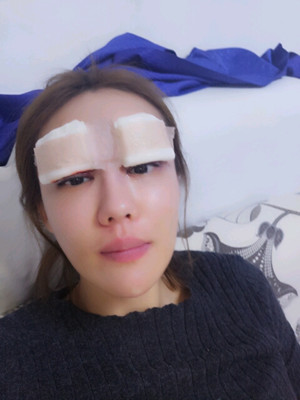 劉中策做的開內(nèi)眼角 眼睛好漂亮