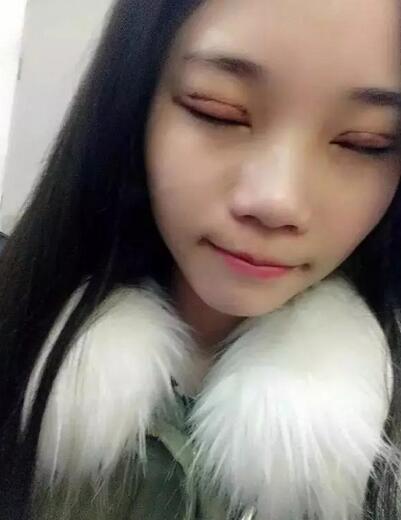 成都蜀尚蓉雅雙眼皮恢復(fù)紀(jì)實 看看果怎么樣