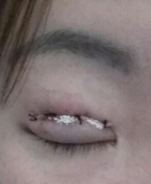 雙眼皮恢復(fù)過程分享