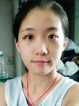 埋線雙眼皮15天恢復(fù)記錄