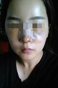 膨體隆鼻手術(shù)前后對比照片，真實案例分享！