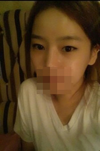 膨體隆鼻手術(shù)前后對比照片，真實案例分享！