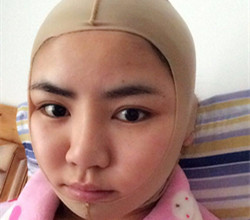 下頜角+顴骨手術(shù)前后過程以及真實果對比圖