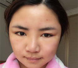 下頜角+顴骨手術(shù)前后過程以及真實果對比圖