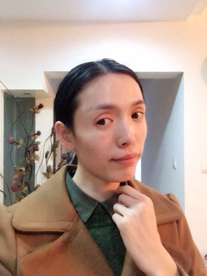 玻尿酸面部填充前后過程及對比圖片，來看看果如何