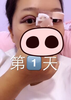 終于把雙眼皮割了，無錫菲尚張樹功做的