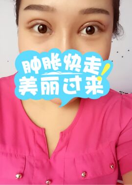 終于把雙眼皮割了，無錫菲尚張樹功做的