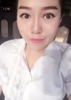 終于把雙眼皮割了，無錫菲尚張樹功做的