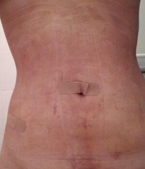 腰腹吸脂后腰線好看太多，肚子也小了