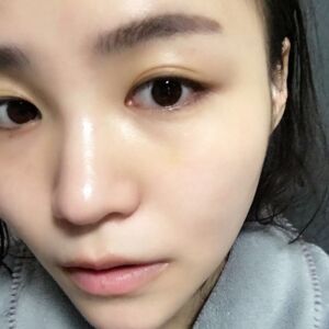 埋埋蛋白線.提升后臉上變得緊致許多，輪廓變得更好看