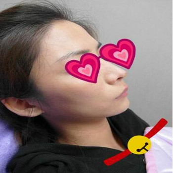 Misko隆鼻讓我鼻子變得挺拔嬌俏無壓力