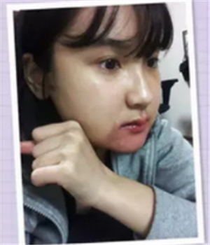 做了磨下頜角整形手術(shù)4個(gè)月了，曬曬我的恢復(fù)前后的對(duì)比照片吧~~