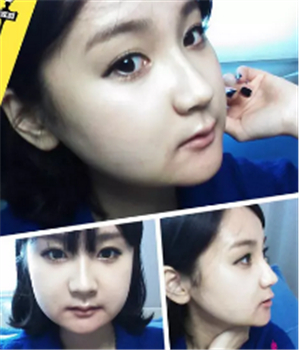 做了磨下頜角整形手術(shù)4個(gè)月了，曬曬我的恢復(fù)前后的對(duì)比照片吧~~