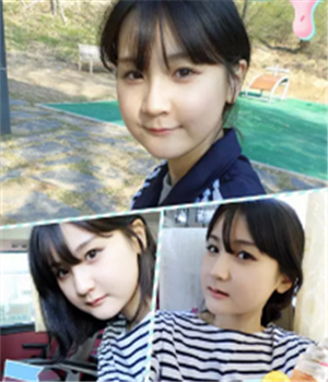 做了磨下頜角整形手術(shù)4個(gè)月了，曬曬我的恢復(fù)前后的對(duì)比照片吧~~