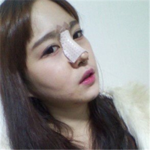 分享我改臉型+硅膠隆鼻手術(shù)前后對(duì)比果照片，伊萊美李湘源做的~