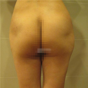 做了自體脂肪移植豐胸手術(shù)，勾勒出**胸部曲線，看看果照片~~