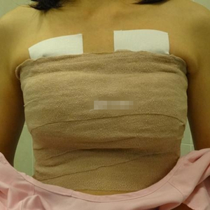 做了自體脂肪移植豐胸手術(shù)，勾勒出**胸部曲線，看看果照片~~