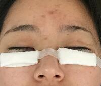 內(nèi)切去眼袋價(jià)格2180元，祛眼袋前后對(duì)比圖分享給大家