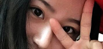 祛眼袋術(shù)后恢復(fù)