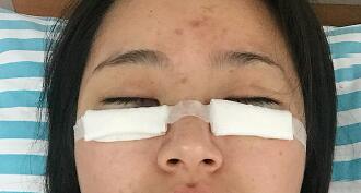 祛眼袋手術(shù)圖，恢復(fù)過程