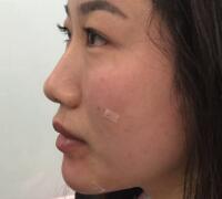 自體脂肪面部填充價(jià)格12800元案例