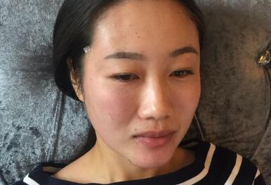 自體脂肪面部填充第二天消了一些腫