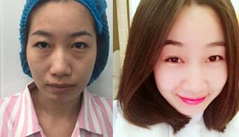 自體脂肪面部填充前后對(duì)比圖