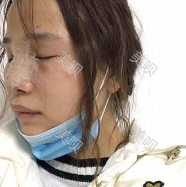 在蘇州常春藤做的硅膠假體隆鼻為大家分享下我的恢復全過程吧