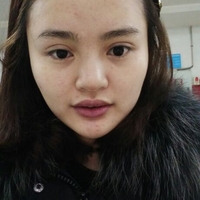 玻尿酸隆鼻花了兩萬多果很自然哦，值~！