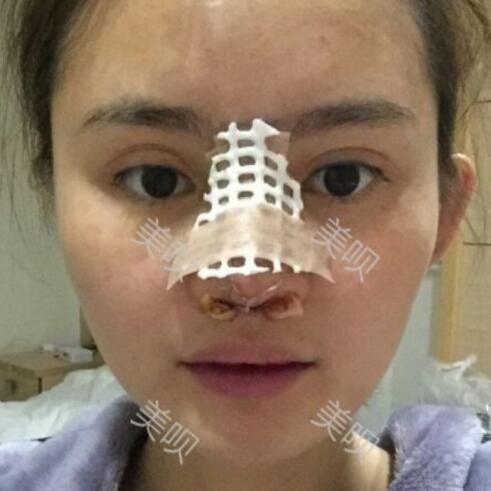 玻尿酸隆鼻花了兩萬多果很自然哦，值~！