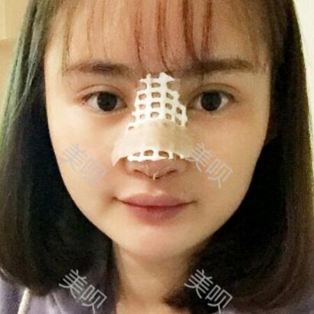 玻尿酸隆鼻花了兩萬多果很自然哦，值~！