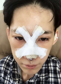 深圳廣和尹衛(wèi)民做的隆鼻整形，大家來(lái)看看果