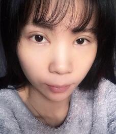 長沙美之峰重瞼+開眼角恢復(fù)過程圖