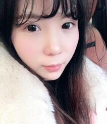 長沙美之峰重瞼+開眼角恢復(fù)過程圖