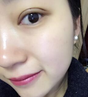 長沙美之峰割雙眼皮3個(gè)月了