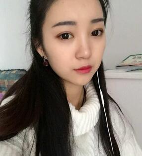 長沙美之峰割雙眼皮3個(gè)月了