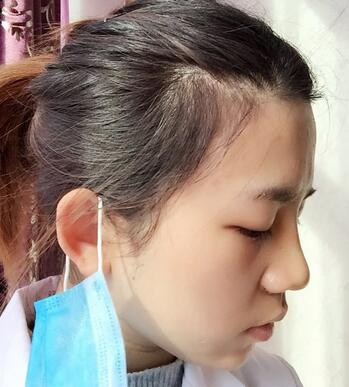 長沙美之峰假體隆鼻恢復(fù)日記