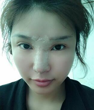 長沙美之峰隆鼻整形手術(shù)恢復(fù)日記圖