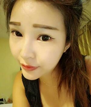 長沙美之峰隆鼻整形手術(shù)恢復(fù)日記圖