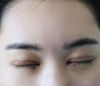 雙眼皮開眼角修復(fù)眼睛終于變得正常好看了