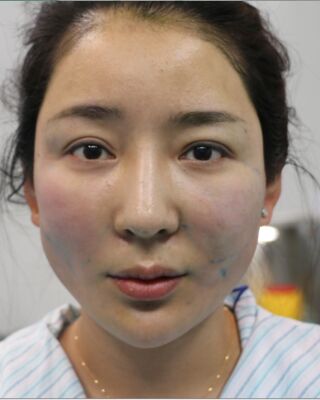 埋埋蛋白線.提升整個(gè)面部年輕很多，小V臉也出來了