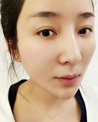 埋埋蛋白線.提升整個(gè)面部年輕很多，小V臉也出來了