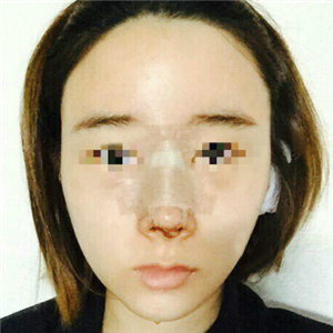蔣醫(yī)生做的隆鼻失敗修復(fù)分享，還有前后對比果圖片哦~