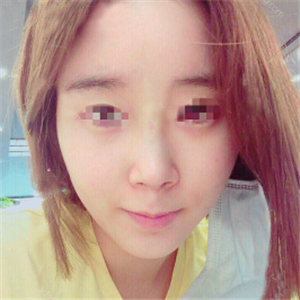 蔣醫(yī)生做的隆鼻失敗修復(fù)分享，還有前后對比果圖片哦~